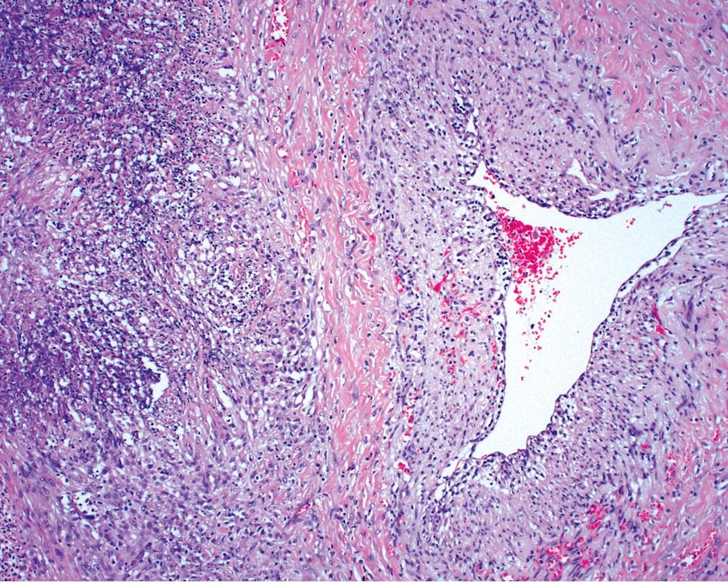 Figure 11.17, Granulomatosis with polyangiitis: vasculitis. Vasculitis at the edge of basophilic necrosis. Note the adventitial fibrosis and expansion of the vascular media by inflammatory cells. Multinucleate giant cells can be seen at the interface of muscularis and adventitia in a focal distribution (lower right) .