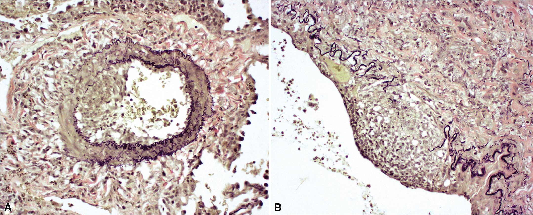 Figure 11.18, Granulomatosis with polyangiitis: elastic tissue stains. (A) Elastic tissue stains demonstrate disruption of the elastic lamina in involved arteries. (B) Granuloma can be seen displacing elastic lamina and protruding into the vessel lumen.