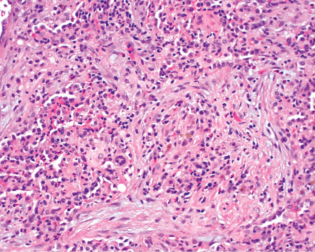 Figure 11.20, Granulomatosis with polyangiitis (GPA): organizing pneumonia. Organization may be prominent in GPA and at times may be the dominant feature. Often capillaritis is evident, as are the “footprints” of previous hemorrhage (hemosiderin at center ). Scattered multinucleate giant cells may be seen.