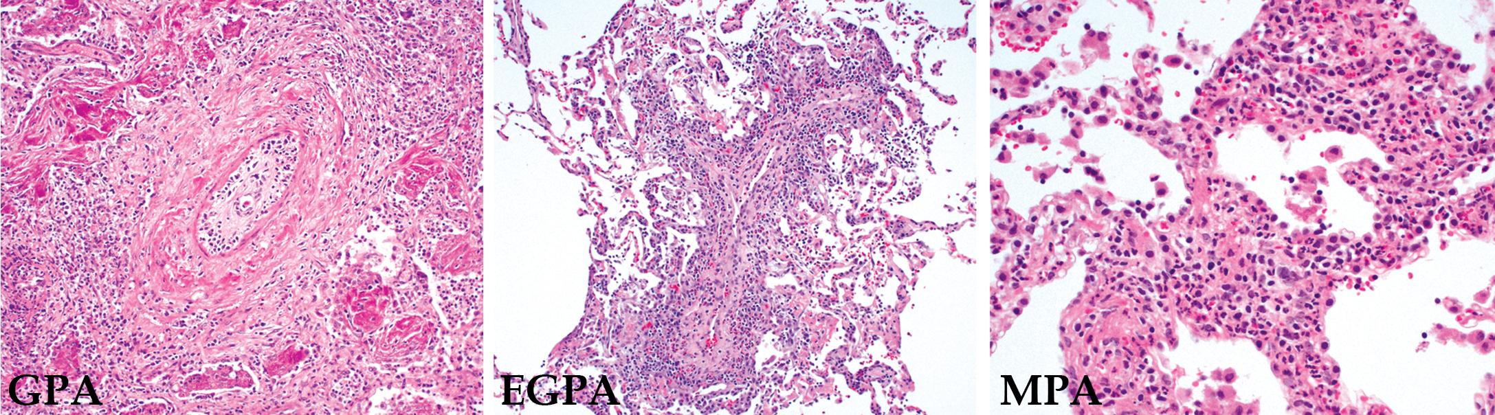 Figure 11.2, Common histopathologic manifestations of pulmonary vasculitis. Histopathologic appearance in three of the most common manifestations of pulmonary vasculitis: Granulomatosis with polyangiitis (GPA) , eosinophilic granulomatosis with polyangiitis (EGPA) , and microscopic polyangiitis (MPA) .