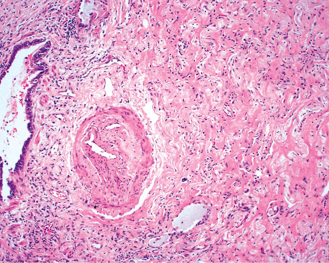 Figure 11.21, Granulomatosis with polyangiitis: treatment effect. Areas of lung fibrosis may occur after treatment for this disorder, frequently associated with parenchymal collapse (right) . Here, a bronchiole and accompanying pulmonary artery show inflammatory sequelae of the disease.