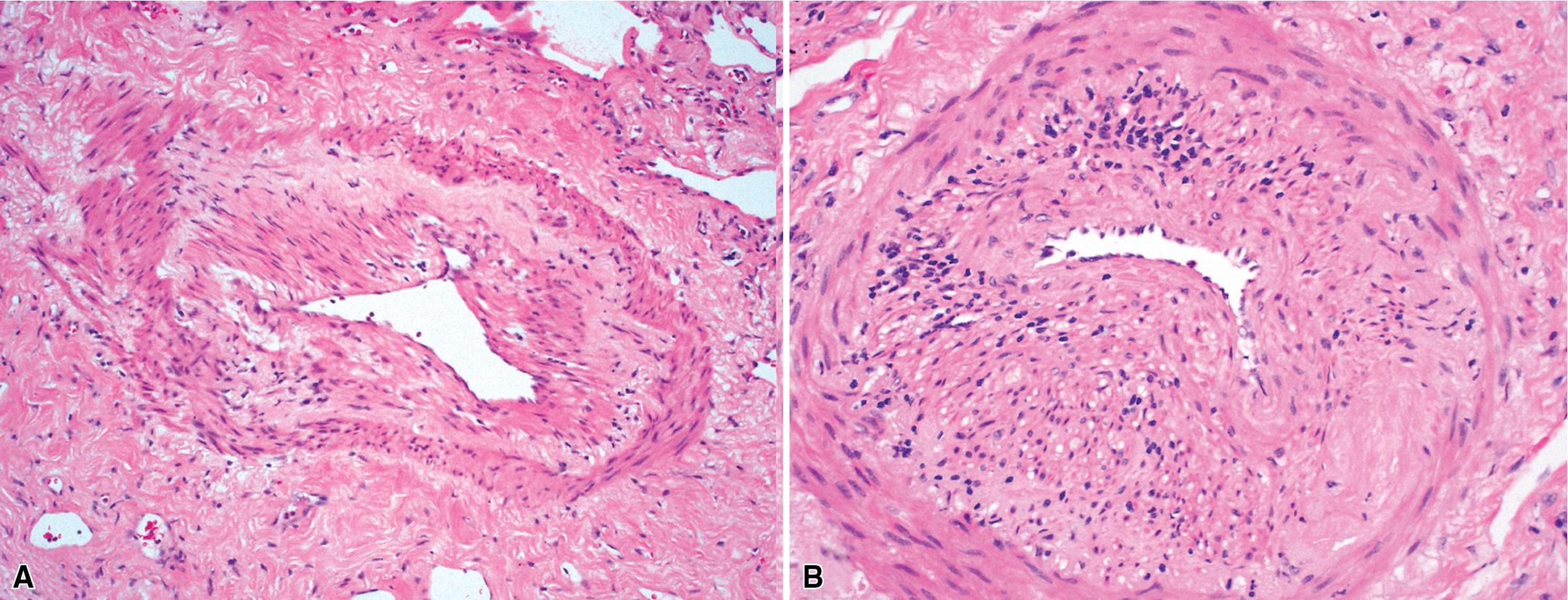 Figure 11.22, Granulomatosis with polyangiitis: treatment effect. (A) Significant vascular scarring consequent to treatment. (B) Remnants of the inflammatory infiltrate may persist within the vascular media. Note the giant cell within the media (upper center) .