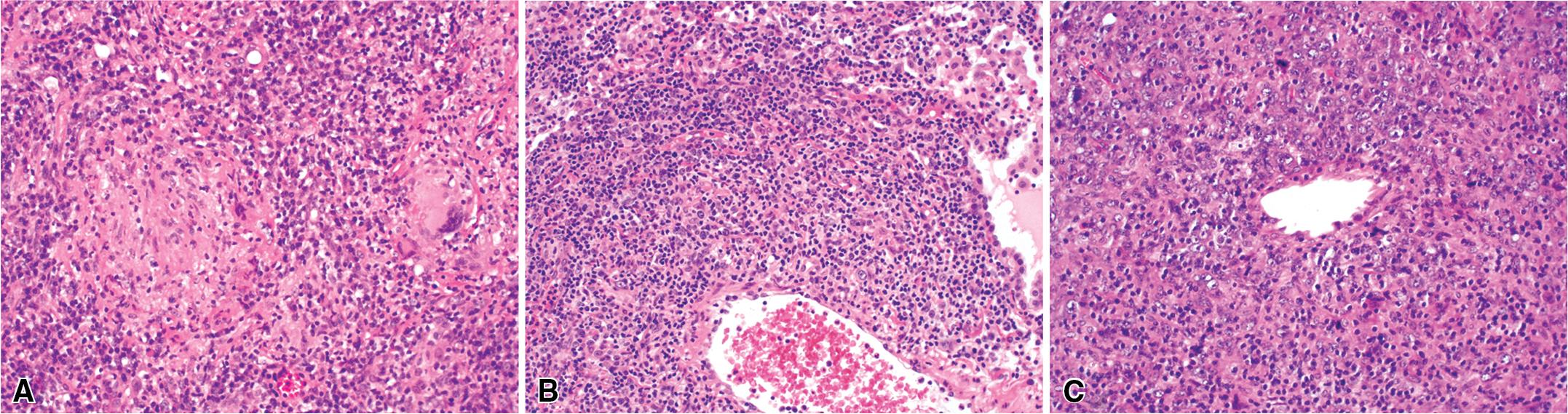 Figure 11.23, Granulomatosis with polyangiitis (GPA): prominent lymphoid infiltrates. (A) GPA may be dominated by lymphocytes. When this occurs, differentiation from lymphoma (specifically, angiocentric lymphoma) may be difficult. (B and C) Note the expansile appearance of the inflammatory infiltrate with vessel wall destruction. Closer inspection will often reveal a degree of atypia in the lymphoid cells not seen in GPA.