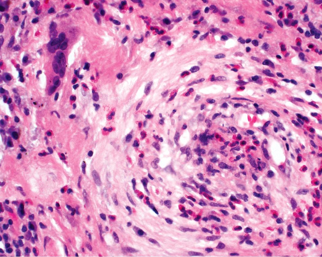 Figure 11.24, Granulomatosis with polyangiitis: prominent eosinophils. When eosinophils are a prominent histopathologic feature, the differential diagnosis will include Churg-Strauss syndrome/eosinophilic granulomatosis with polyangiitis. Here a vessel is obliterated by inflammation and fibroblastic proliferation, and eosinophils are abundant. Note the multinucleate giant cell in the upper left .