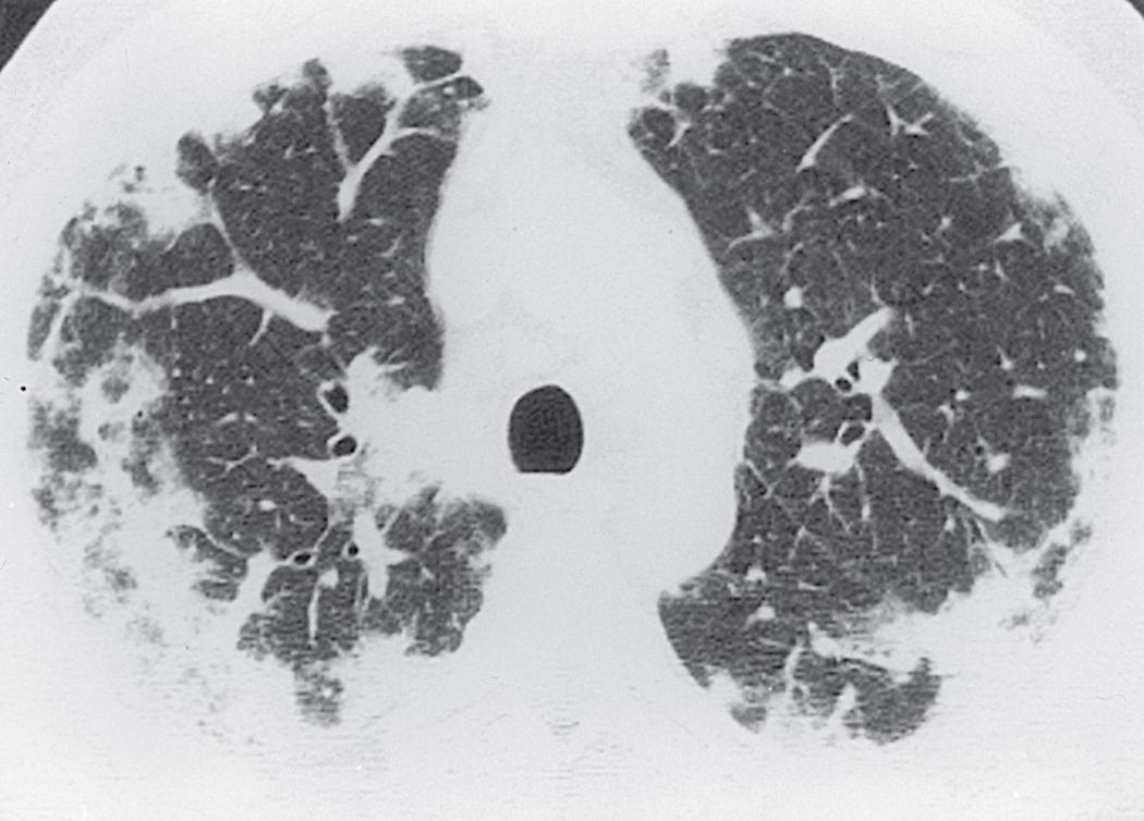 Figure 11.25, Eosinophilic granulomatosis with polyangiitis (EGPA)/Churg-Strauss syndrome: computed tomography (CT) features. Chest CT scan (lung window) in a patient with a 10-year history of asthma and peripheral eosinophilia demonstrates multifocal peripheral subpleural consolidations. The diagnosis of EGPA was confirmed at open lung biopsy.