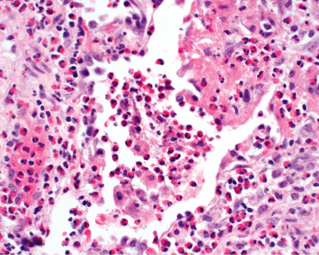 Figure 11.26, Eosinophilic granulomatosis with polyangiitis (EGPA): eosinophilic pneumonia. Eosinophilic pneumonia is the most consistent manifestation of EGPA. Here, the triad of air space eosinophils, eosinophilic macrophages with fibrin, and atypical alveolar lining cells can be readily appreciated.