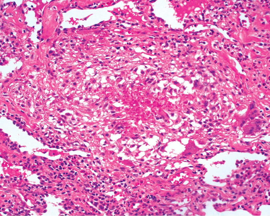 Figure 11.27, Eosinophilic granulomatosis with polyangiitis: allergic granulomas. Characteristic allergic granuloma is readily apparent. Note the vaguely palisaded histiocytes at the periphery of eosinophilic necrosis (center) . Multinucleate giant cells may be present and typically have a brightly eosinophilic cytoplasm.