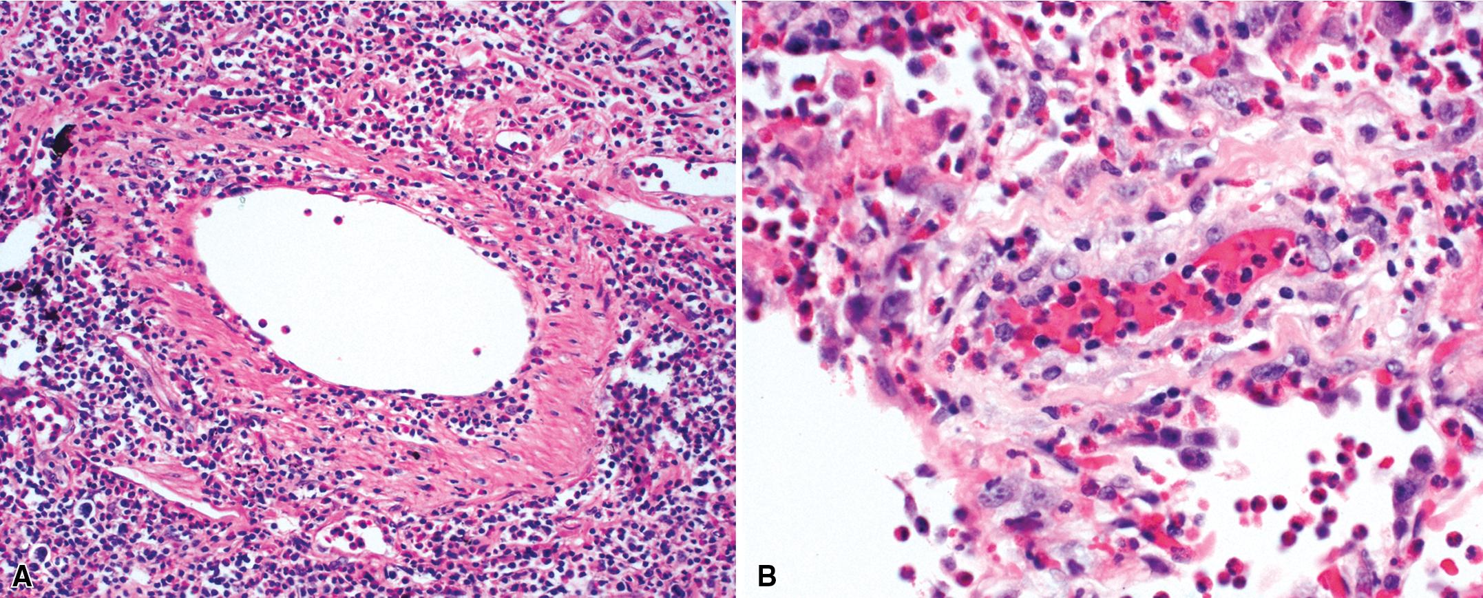 Figure 11.28, Eosinophilic granulomatosis with polyangiitis (EGPA): vasculitis. Vasculitis is characteristic in EGPA. (A) A medium-sized artery infiltrated by eosinophils and scattered lymphocytes. (B) A venule infiltrated by eosinophils. Note fibrin and eosinophils in surrounding air spaces.