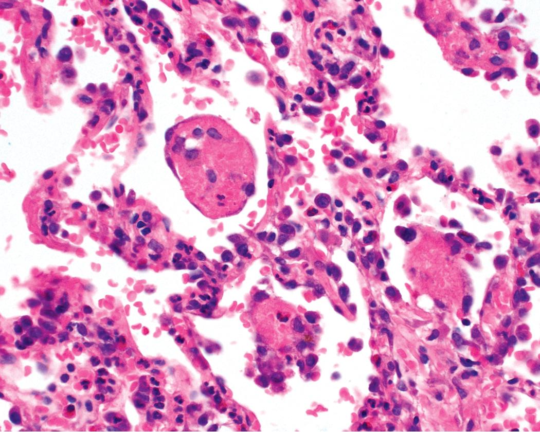 Figure 11.29, Eosinophilic granulomatosis with polyangiitis (EGPA): pulmonary hemorrhage. Diffuse pulmonary hemorrhage with capillaritis can occur in EGPA. Capillaritis is demonstrated here, associated with aggregated air space fibrin and eosinophils.