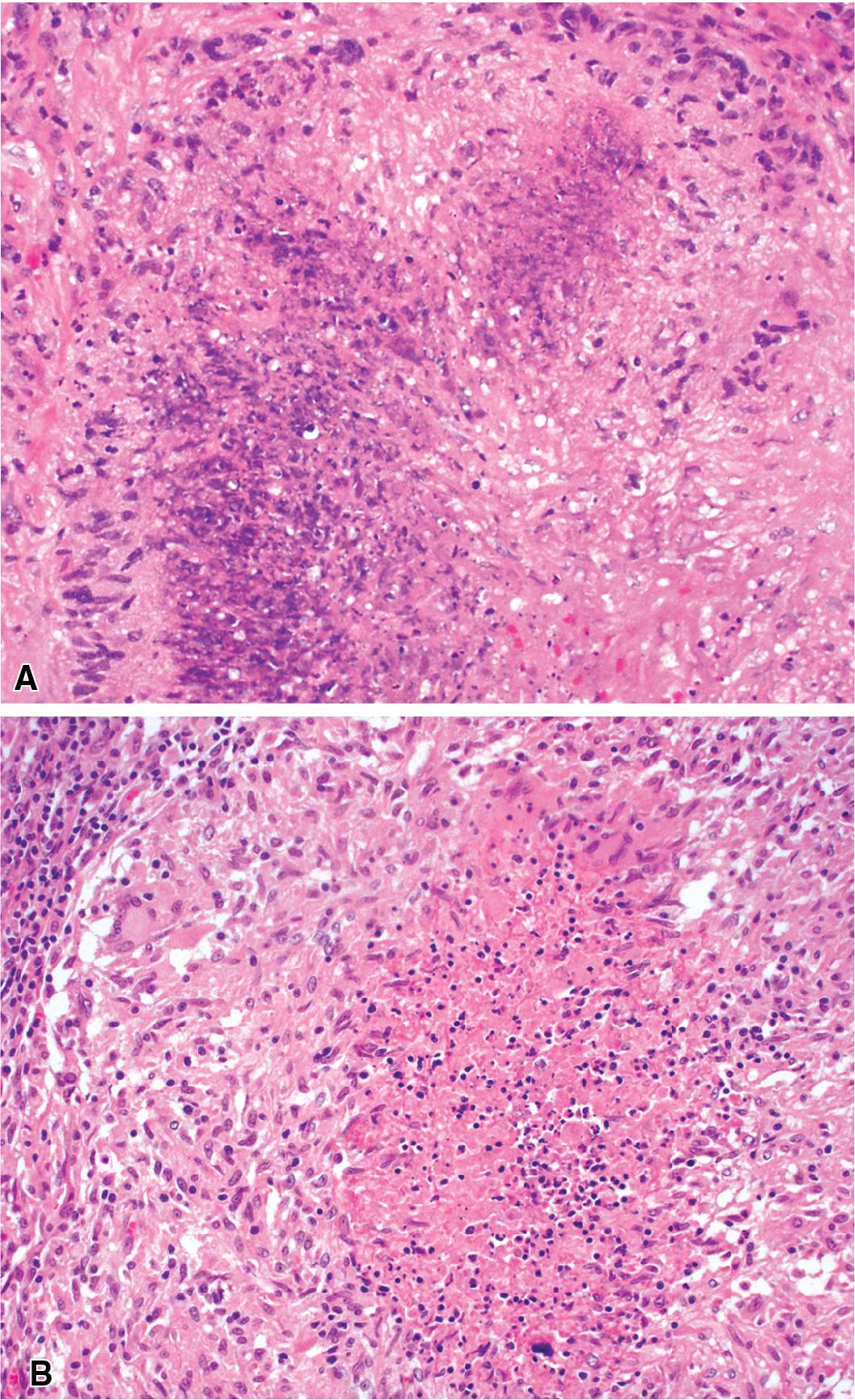 Figure 11.3, The granulomas of granulomatosis with polyangiitis (GPA). GPA granulomas (A) tend to be more palisaded than those seen in granulomatous infection (B). Also note the blue (basophilic) necrosis of GPA, compared with the pink (eosinophilic) necrosis of infection.