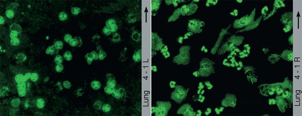 Figure 11.4, Antineutrophilic cytoplasmic antibody (ANCA) immunofluorescence. Left , Cytoplasmic staining of neutrophils characterizes the c-ANCA pattern. Right , Perinuclear accentuation of staining is seen with the p-ANCA pattern.