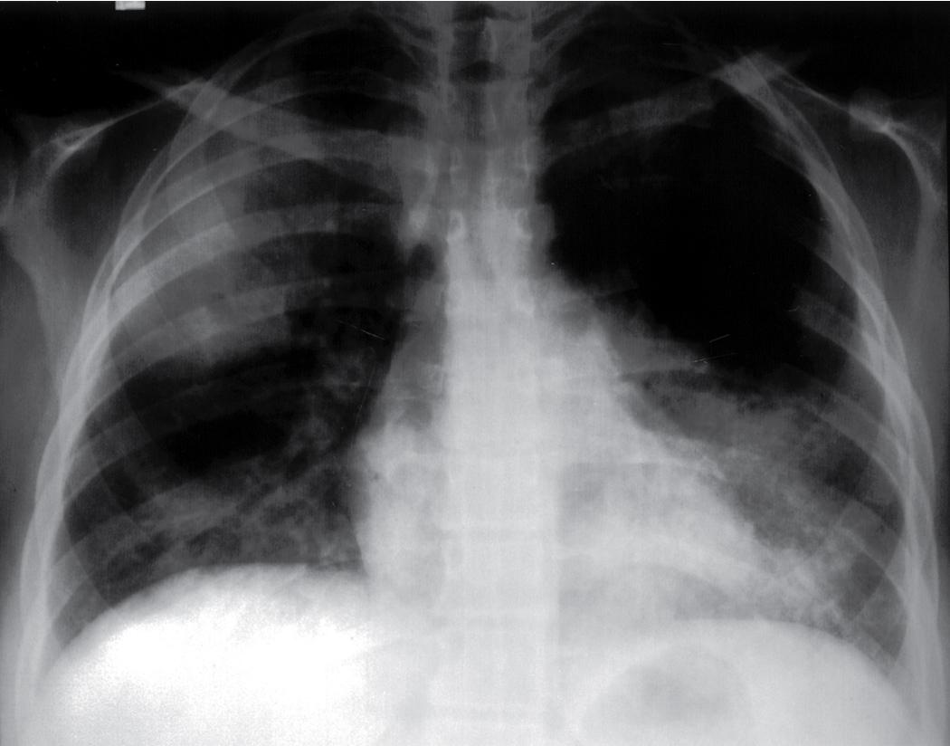 Figure 11.5, Granulomatosis with polyangiitis (GPA): radiographic features. Posteroanterior chest radiograph from a patient with GPA. Note the multifocal nodules, some of which appear cavitated.