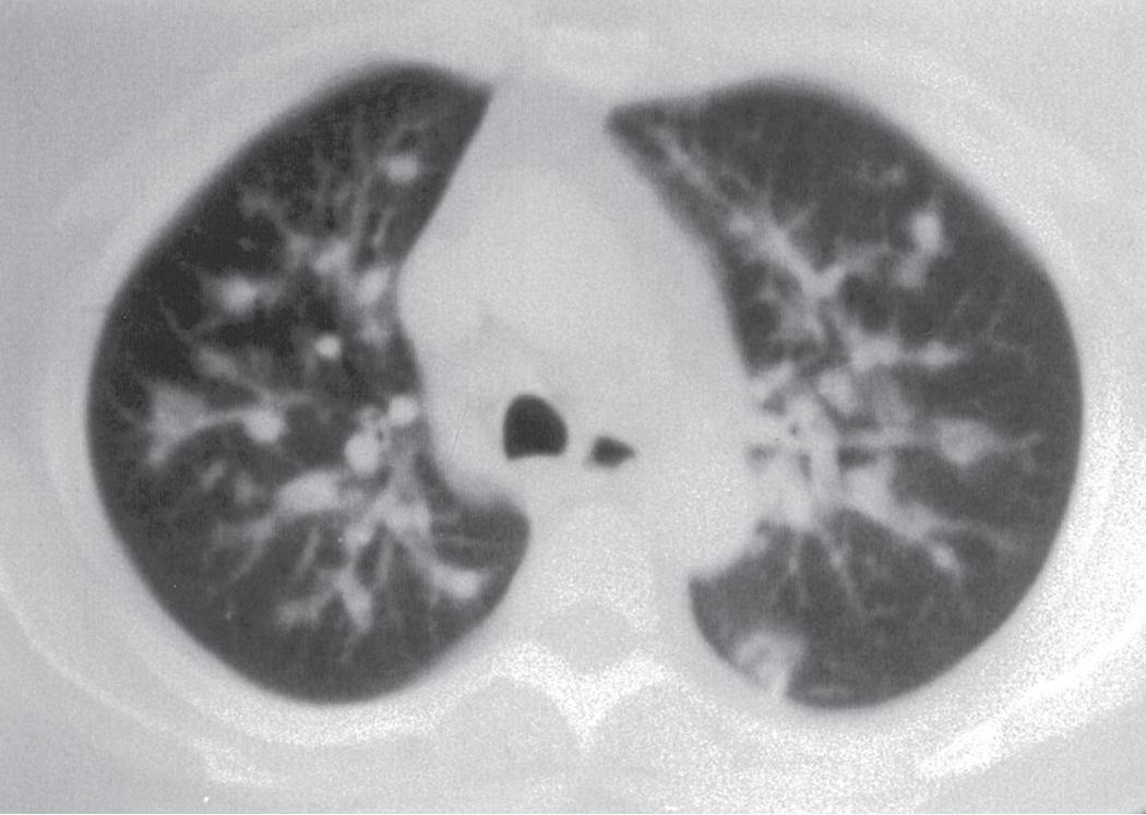 Figure 11.6, Granulomatosis with polyangiitis: computed tomography (CT) features. Chest CT scan (lung window) demonstrates multifocal, ill-defined small nodular opacities in close relationship to pulmonary arteries. Note the thick walls of these well-marginated lesions.