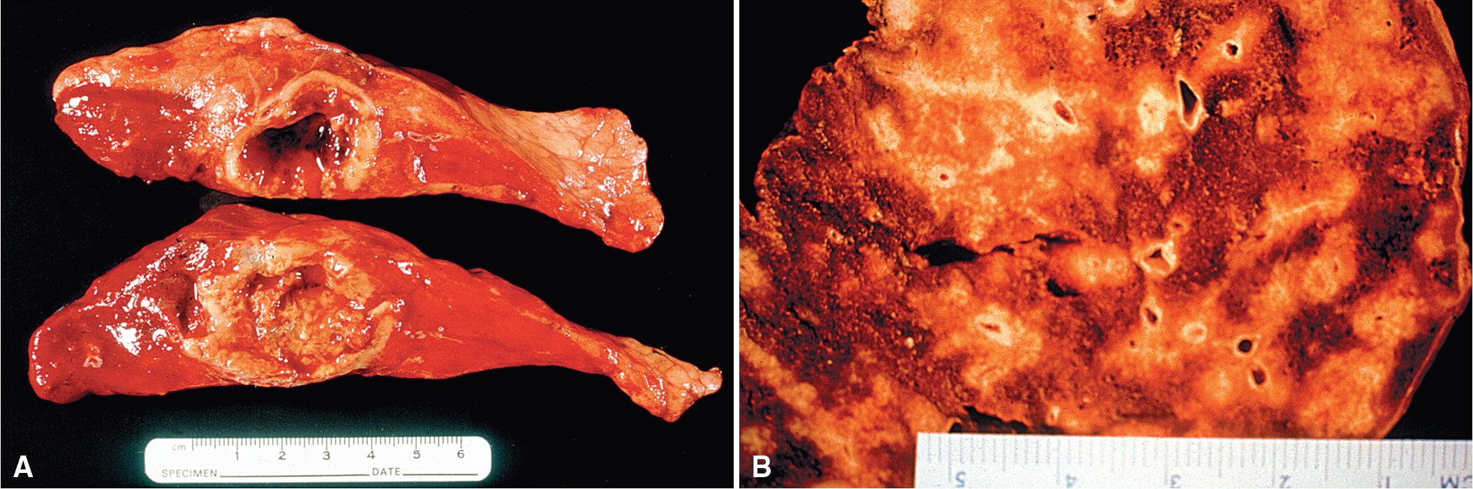 Figure 11.7, Granulomatosis with polyangiitis: gross specimen. (A) This necrotizing granuloma is cavitated with a necrotic center and an inflammatory border. (B) Multiple scattered nodular foci of consolidation are present. Yellow-white areas represent necrosis.