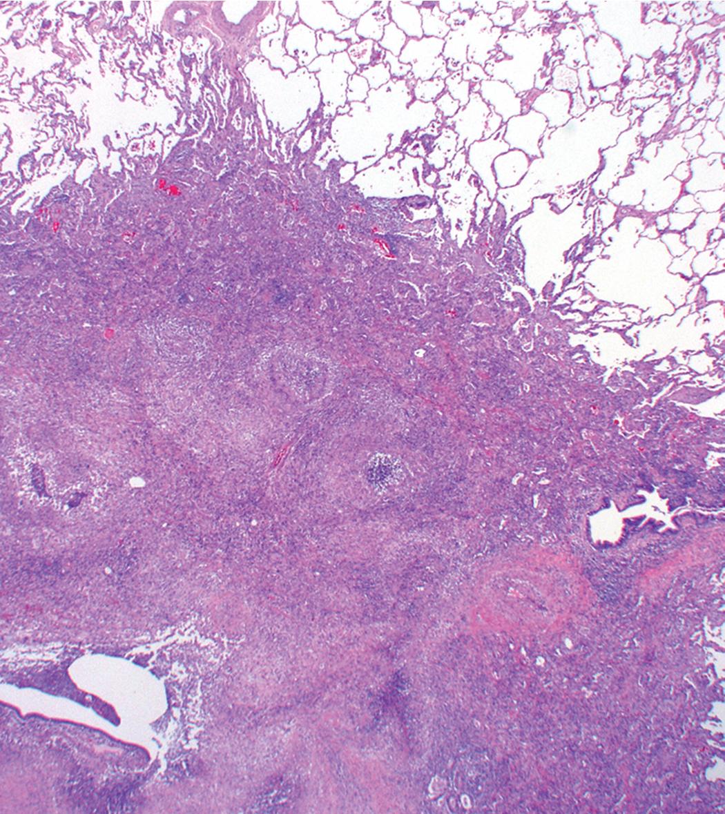 Figure 11.8, Granulomatosis with polyangiitis: nodular lesions. A characteristic nodular lesion seen at scanning magnification shows the thick inflammatory wall surrounding irregular zones of basophilic necrosis. Note the airways and arteries visible within the lesion.