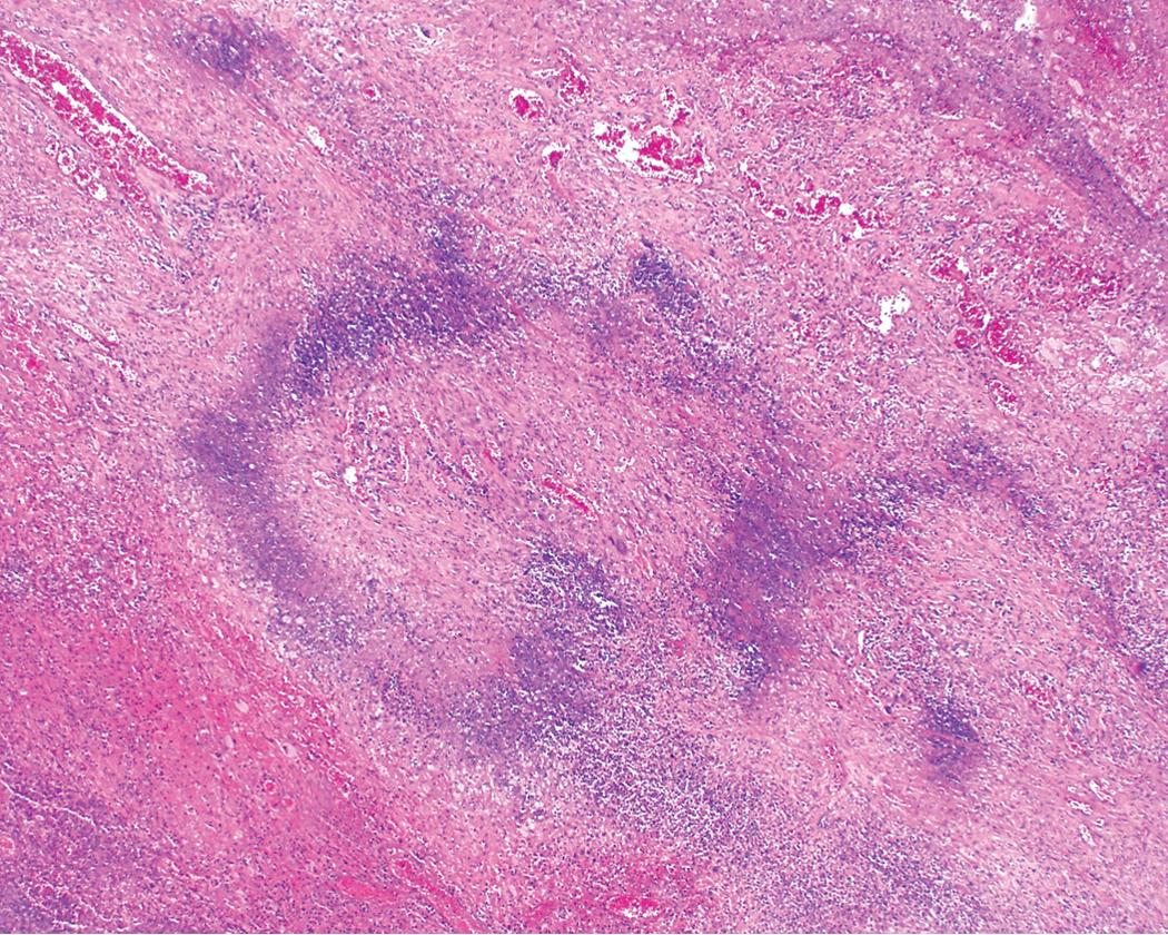 Figure 11.9, Granulomatosis with polyangiitis: geographic necrosis. The basophilic necrosis can be appreciated at scanning magnification.