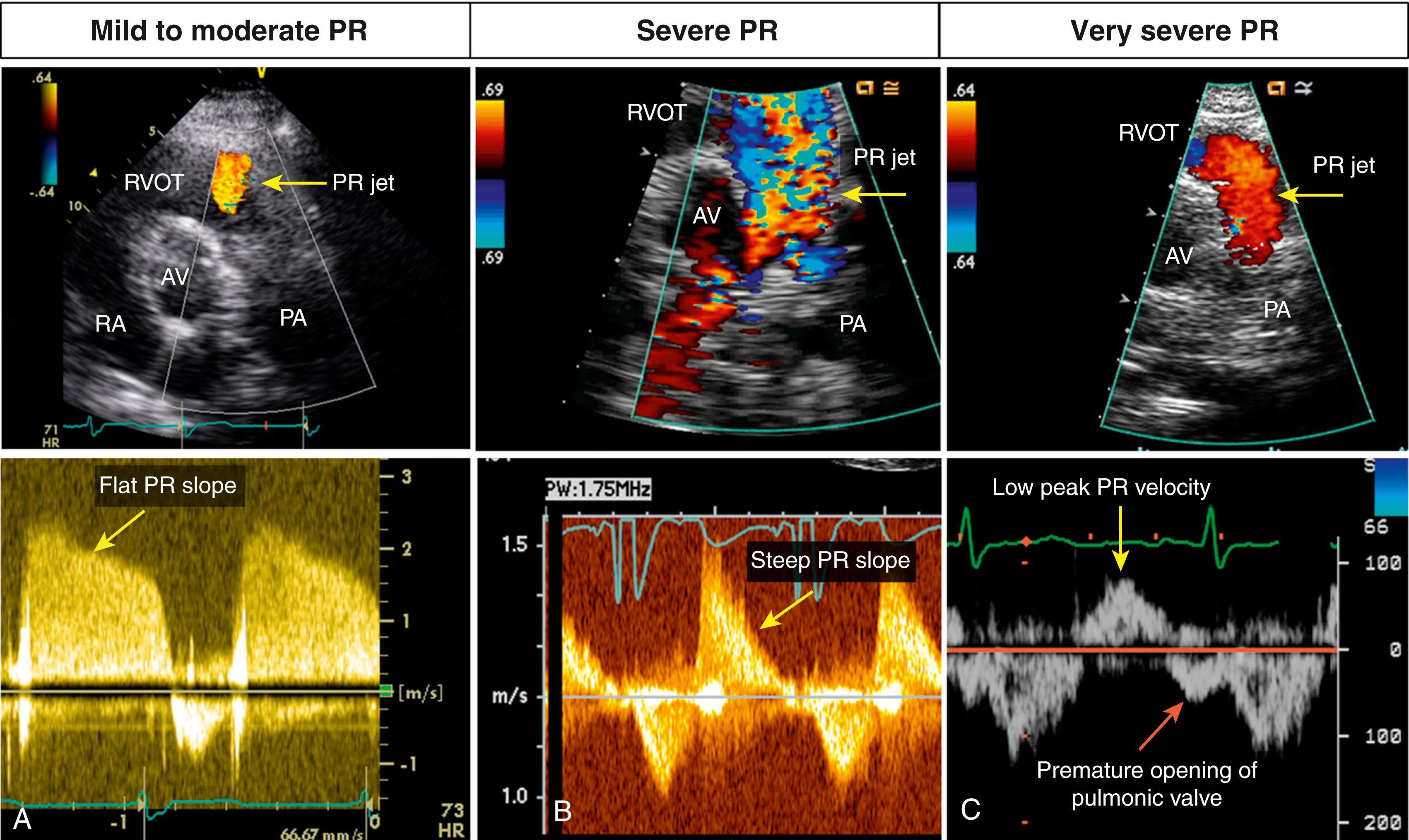 Figure 107.1, Color and spectral Doppler markers of pulmonic regurgitation (PR). Transthoracic short-axis view at the level of the aortic valve demonstrate color Doppler (top) and spectral Doppler (bottom) findings in mild to moderate, severe, and very severe PR. A. Mild to moderate PR . On color Doppler, the jet is small (arrow) , and vena contracta at the jet origin is narrow. On spectral Doppler, the slope of PR jet is relatively flat (arrow) . B, Severe PR. On color Doppler, the jet is large and turbulent (arrow) , but on spectral Doppler, the PR slope is steep (arrow) . C, Very severe PR. On color Doppler, the jet is laminar (arrow) and of short duration. On spectral Doppler, there is a low peak velocity of PR jet (yellow arrow) , and there is premature opening of pulmonic valve with abnormal antegrade flow in late diastole. AV, Aortic valve; RA, right atrium; RVOT, right ventricular outflow tract. (See accompanying Video 107.1A , Video 107.1B , Video 107.1C .)