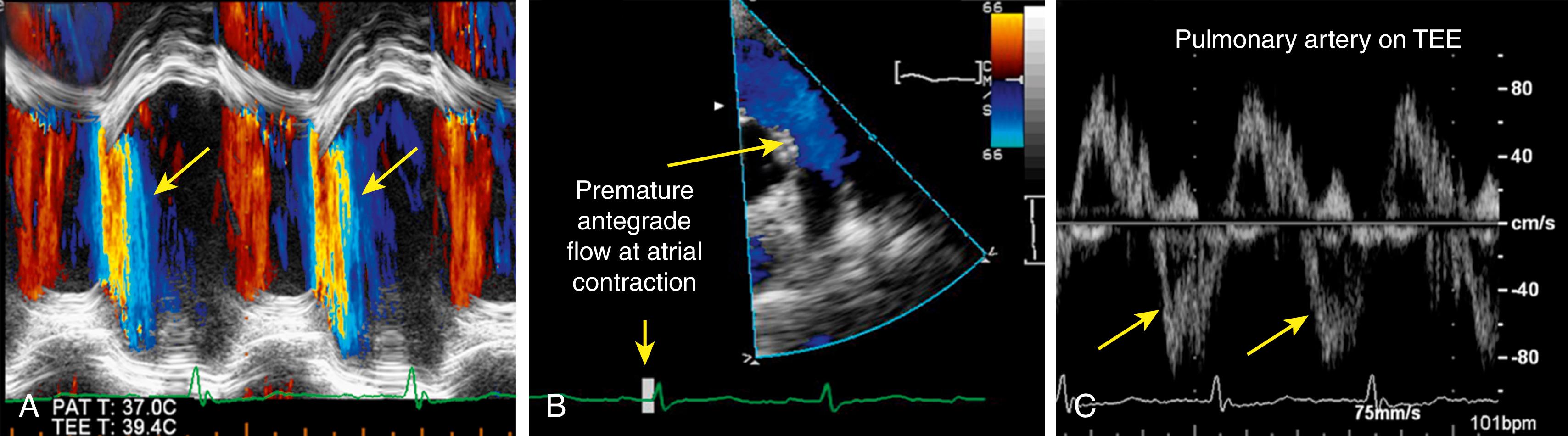 Figure 107.2, Additional markers of severe pulmonic regurgitation (PR). A, Color M-mode echocardiography demonstrates that PR jet terminates abnormally in early diastole (arrows) . This is in contrast to less severe forms of PR in which the PR jet lasts throughout the diastole. B, Color Doppler on a transthoracic short-axis view at the level of the aortic valve demonstrates abnormal antegrade flow across the pulmonic valve at the time of atrial contraction indicative of premature pulmonic valve opening resulting from elevated right ventricular pressures in severe PR. C , Transesophageal echocardiography (TEE) spectral Doppler tracing demonstrates abnormal holodiastolic flow reversal in the pulmonary artery indicative of severe PR.