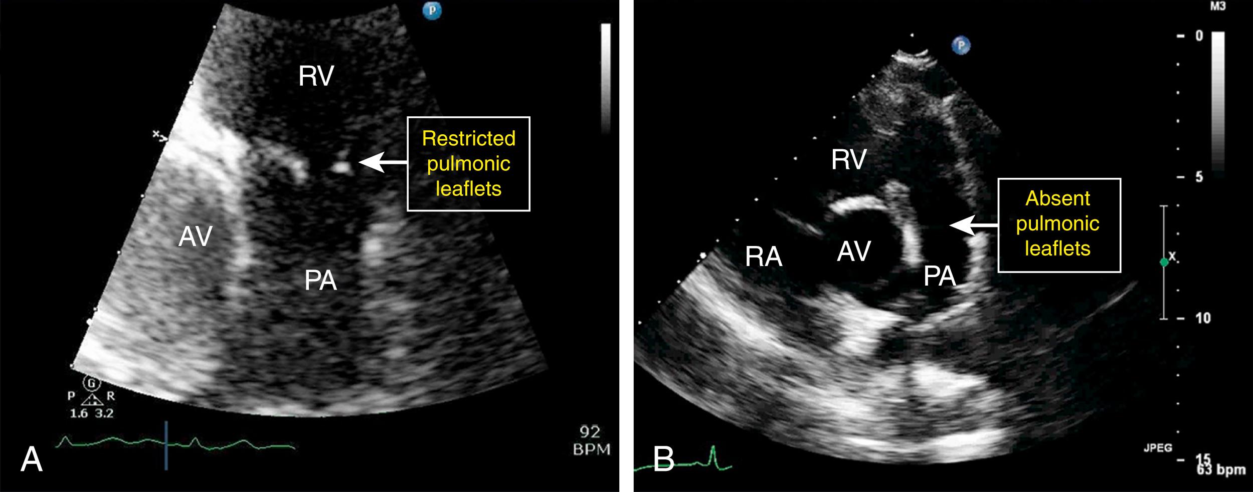 Figure 107.3, Causes of severe pulmonic regurgitation (PR). A, Carcinoid disease of the pulmonic valve. B, Severe PR occurring decades after surgical repair of tetralogy of Fallot. AV, Aortic valve; PA, pulmonary artery; RA, right atrium; RV, right ventricle. (See accompanying Video 107.3A , Video 107.3B .)