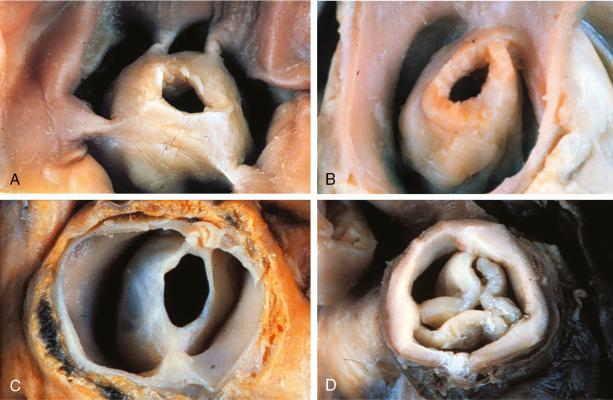 Fig. 24.1, Pathologic Specimens of Congenital Pulmonic Valve Stenosis.