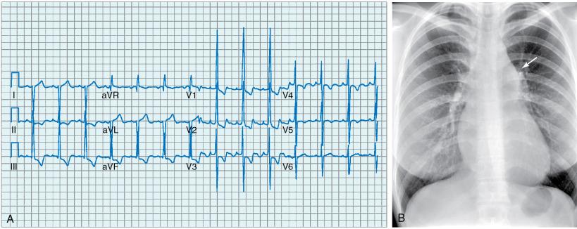 Fig. 24.2, Electrocardiogram and Chest Radiograph of a Patient With Severe Valvular Pulmonic Stenosis.