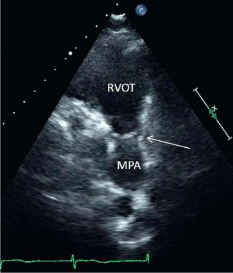 Fig. 24.3, Valvular Pulmonic Stenosis (Video 24. 3 ).