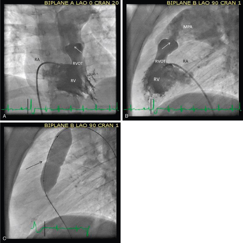 Fig. 24.4, Valvular Pulmonic Stenosis.