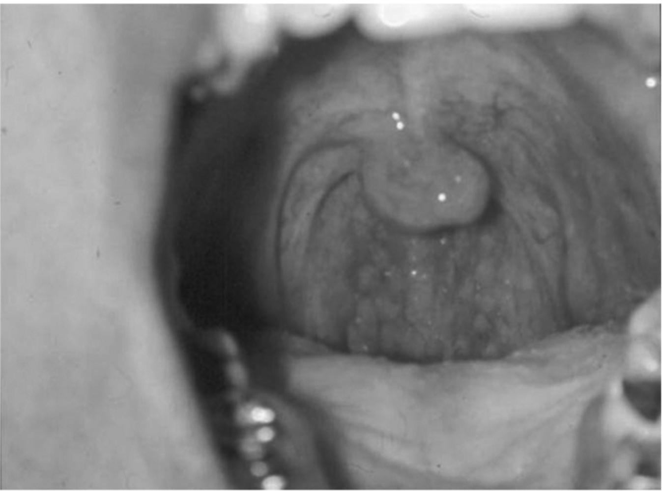 Fig. 16.1, Cobblestone appearance of the posterior pharynx from postnasal drip.