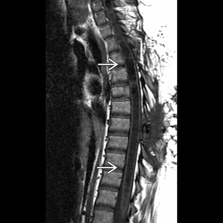 Sagittal T1WI MR in the same patient 1 year later now shows marked expansion of the syrinx throughout the thoracic cord .