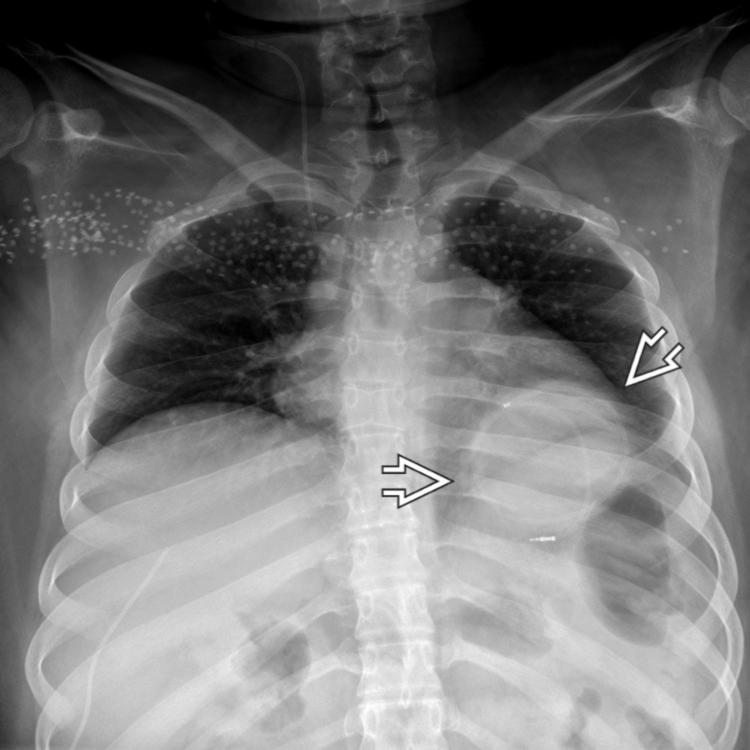 AP chest film in the same patient shows a loculated pleural collection at the site of the coiled shunt catheter .