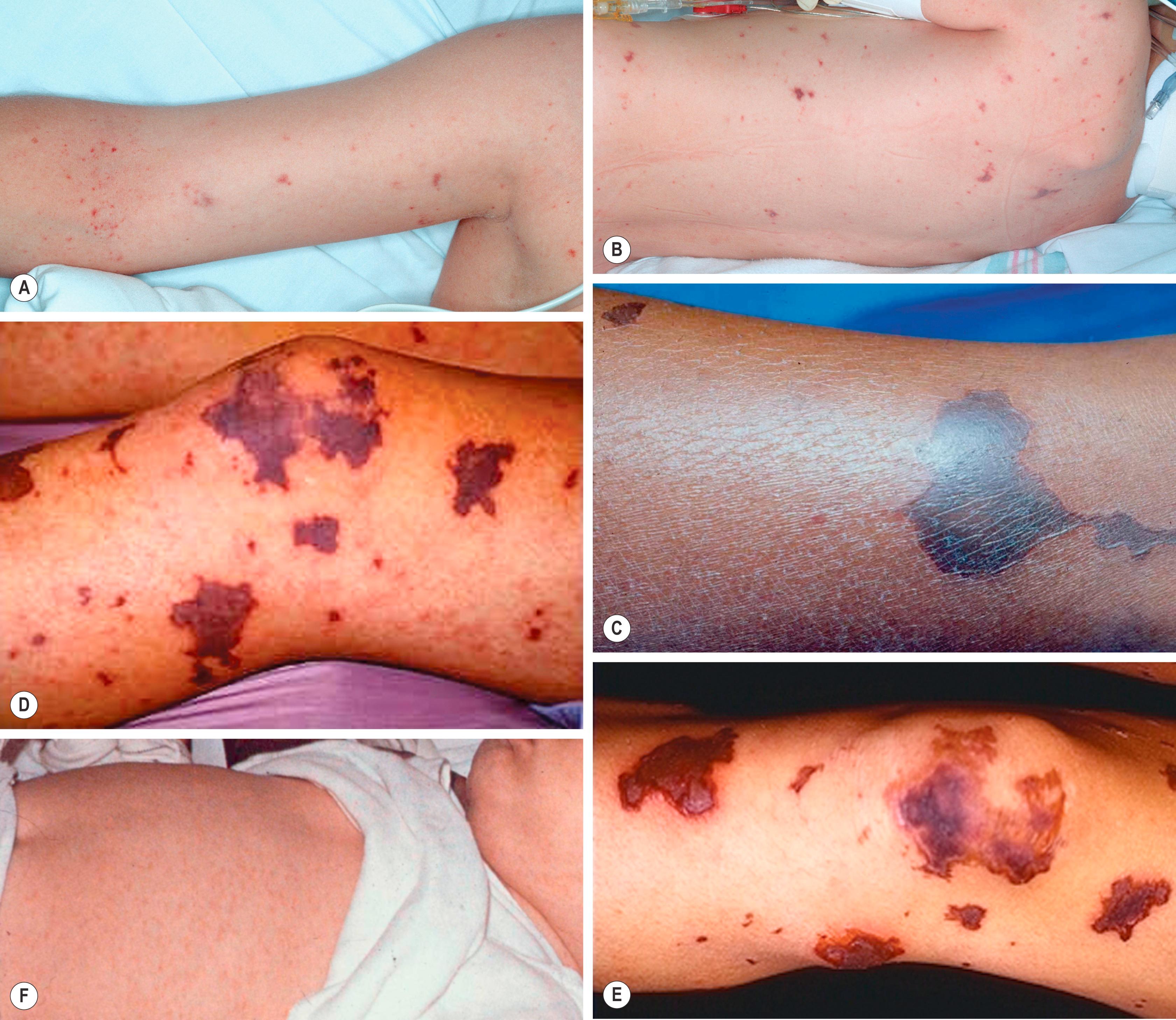 FIGURE 70.1, Skin manifestations of meningococcemia. The examination of one patient with this rapidly progressive disease found petechiae on the arm with exaggeration distal to the site of a tourniquet (A) and petechiae and purpura on the back (B). Another patient had a purpuric plaque on the distal leg (C), and purpuric lesions were seen around the knee in a patient at the time of admission (D) and 4 days later (E). Early manifestations of rapidly progressive, fatal meningococcemia include predominantly nonpetechial, macular lesions (F).