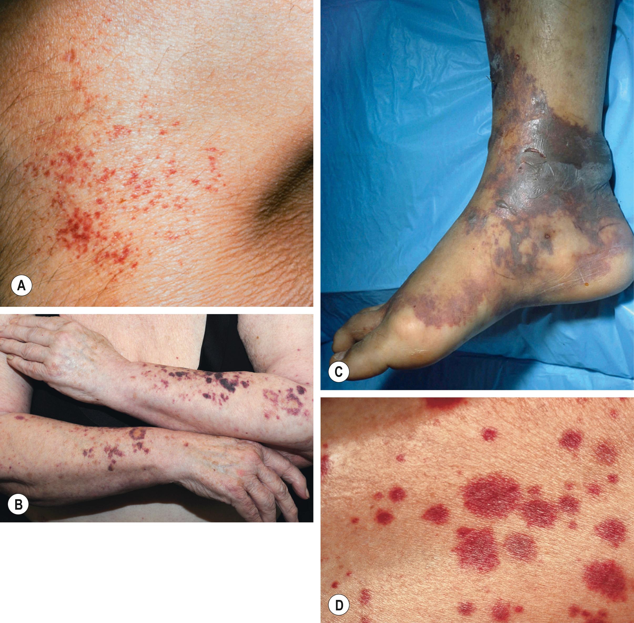 Fig. 18.1, Clinical examples of petechiae and purpura.