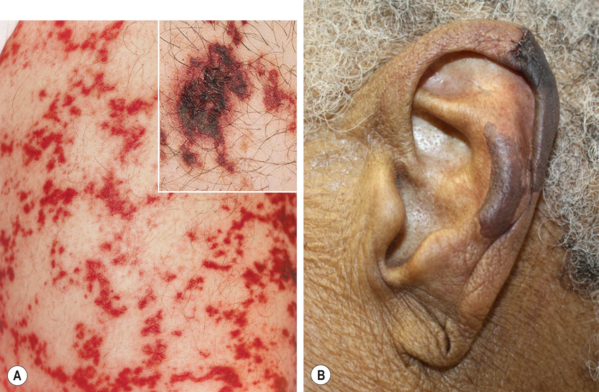 Fig. 18.3, Type I cryoglobulinemia in a patient with multiple myeloma (IgG type).