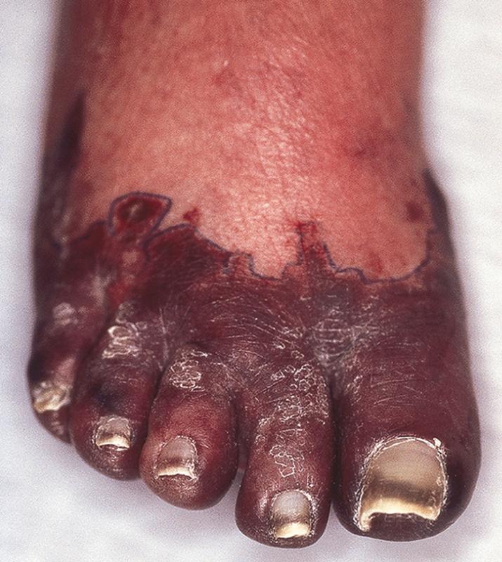 Fig. 18.4, Retiform purpura in antiphospholipid syndrome.