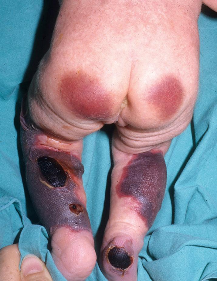 Fig. 18.7, Protein C deficiency in an infant. Large purpuric plaques, with development of bullae and necrotic ulcerations within those on the lower extremities. Note the retiform purpura surrounding the heel ulcer.