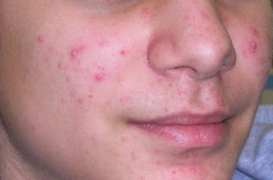 Figure 12.1, Acne – characteristic papules and pustules in a teenager.