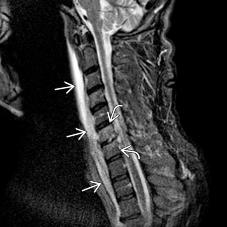 Sagittal STIR MR shows increased fluid in the retropharyngeal/prevertebral space . Marrow edema in C6 and C7 vertebral bodies is seen . There is fluid signal within the disc space with irregularity along the endplate cortical margins.
