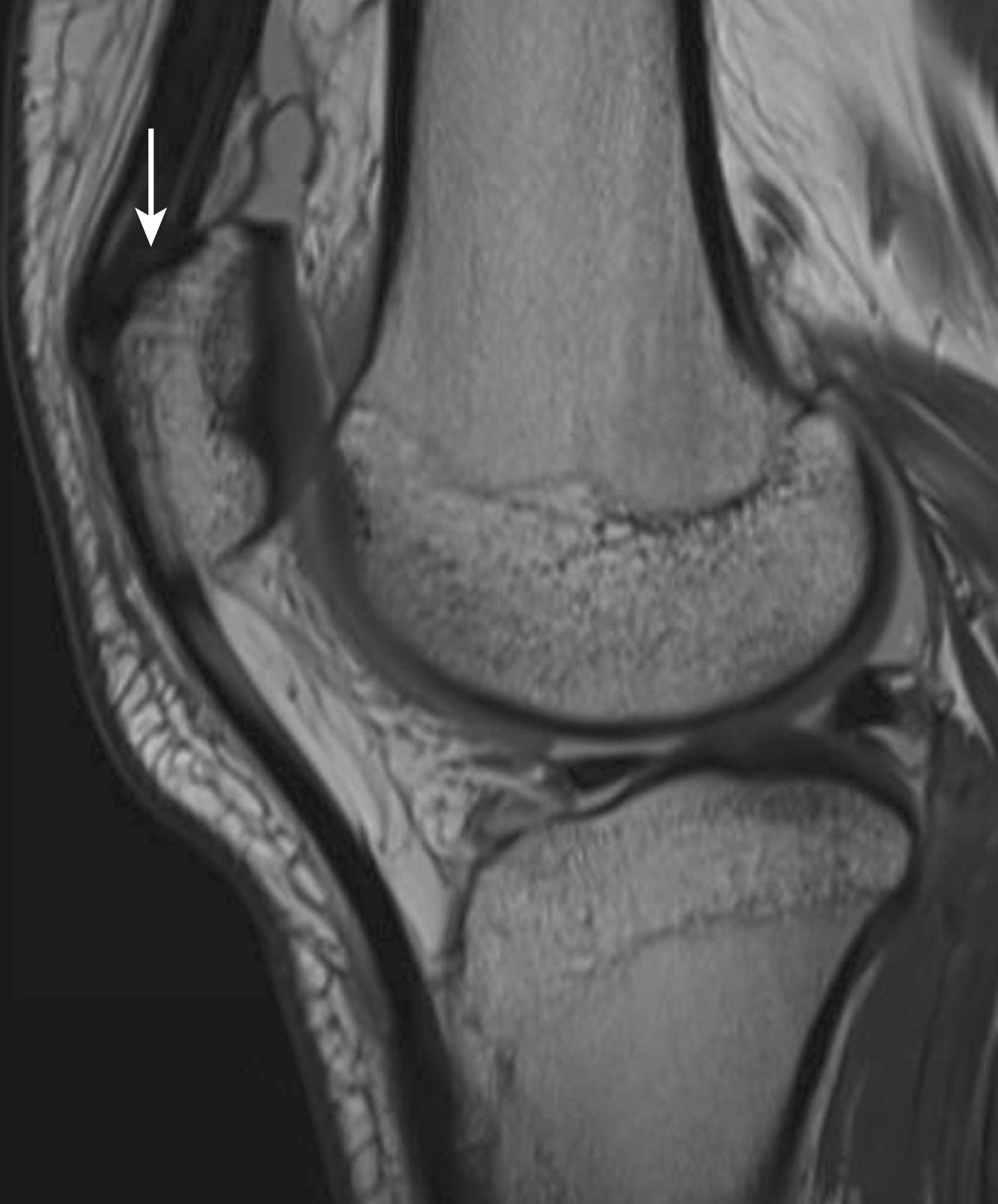 Fig. 34.1, Note the relative anterior attachment of the quadriceps tendon to the patella in a normal knee. It is important to restore the tendon to the anatomical footprint when surgical repair is performed.