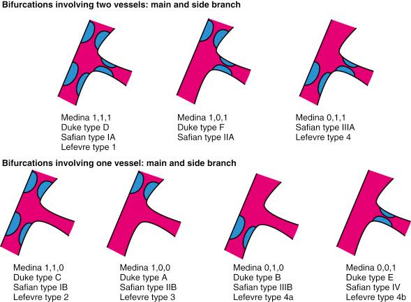 Fig. 64.1, Schematic classification systems for types of bifurcation stenoses.