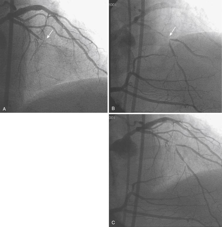 Fig. 64.2, Simultaneous coronary injections to visualize contralateral collaterals.