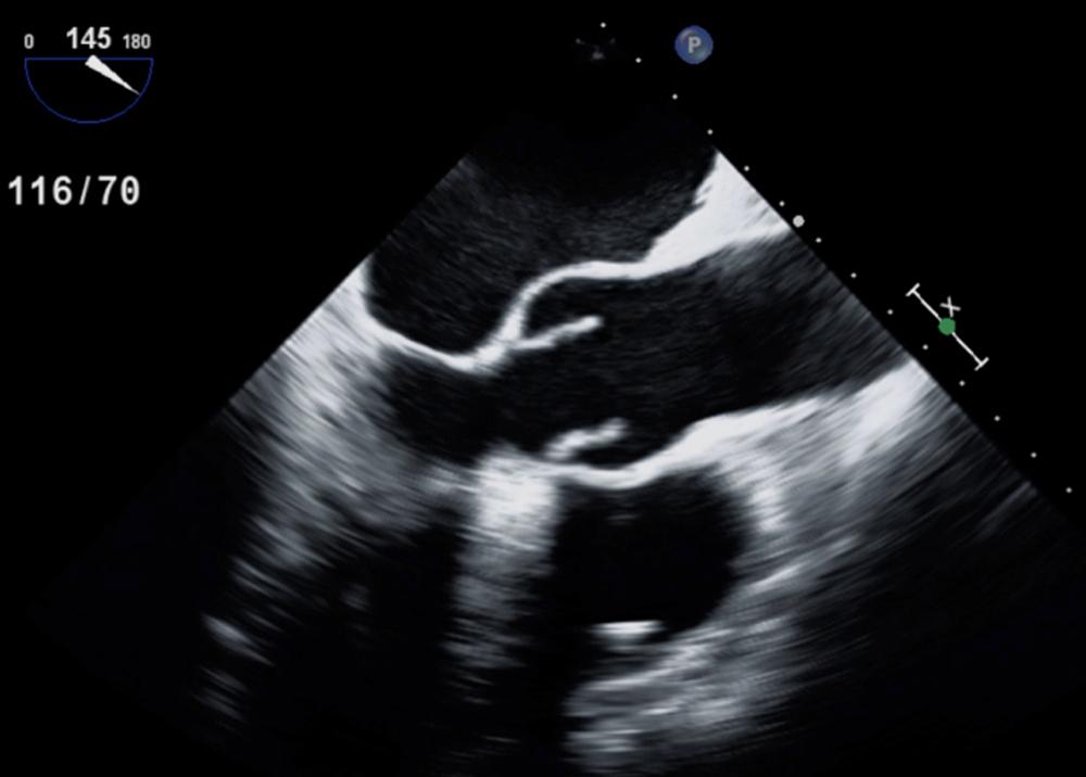 Figure 79.1, Transesophageal echocardiogram, longitudinal view (similar to transthoracic parasternal long-axis view) of a normal tricuspid aortic valve illustrates normal opening with the leaflets parallel to the aortic root walls.