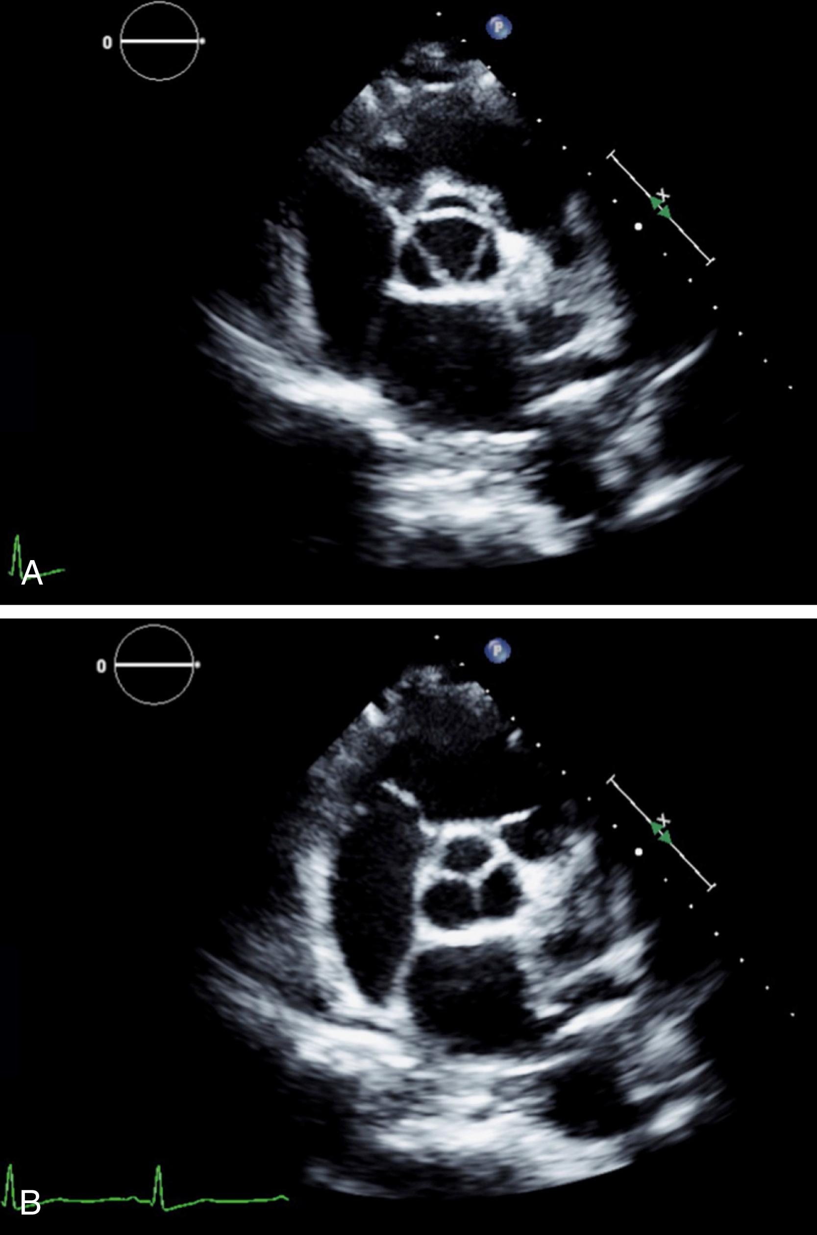 Figure 79.2, Transthoracic echocardiogram (short-axis view) of a normal tricuspid aortic valve. A , In systole, the valve opens in a triangular fashion with straightening of the leaflets. B , In diastole, the normal trileaflet valve appears like a Y, with the commissures at the 10 o’clock, 2 o’clock, and 6 o’clock positions.