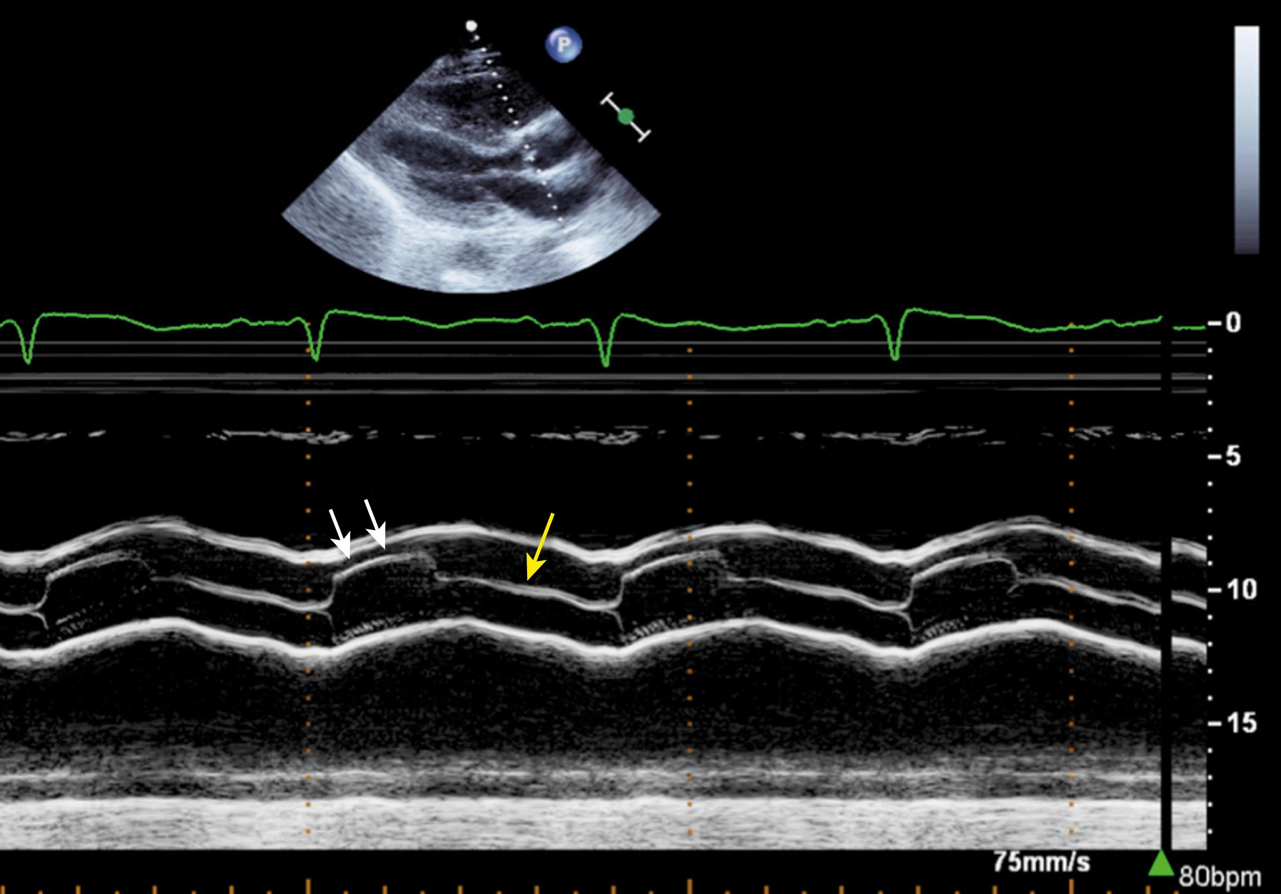 Figure 79.3, M-mode echocardiogram of an aortic valve illustrating the rapid opening slope of the aortic leaflets at the onset of systole, the leaflets aligned parallel to the aortic walls throughout systole (white arrows) , and the central closure line in diastole (yellow arrow) .
