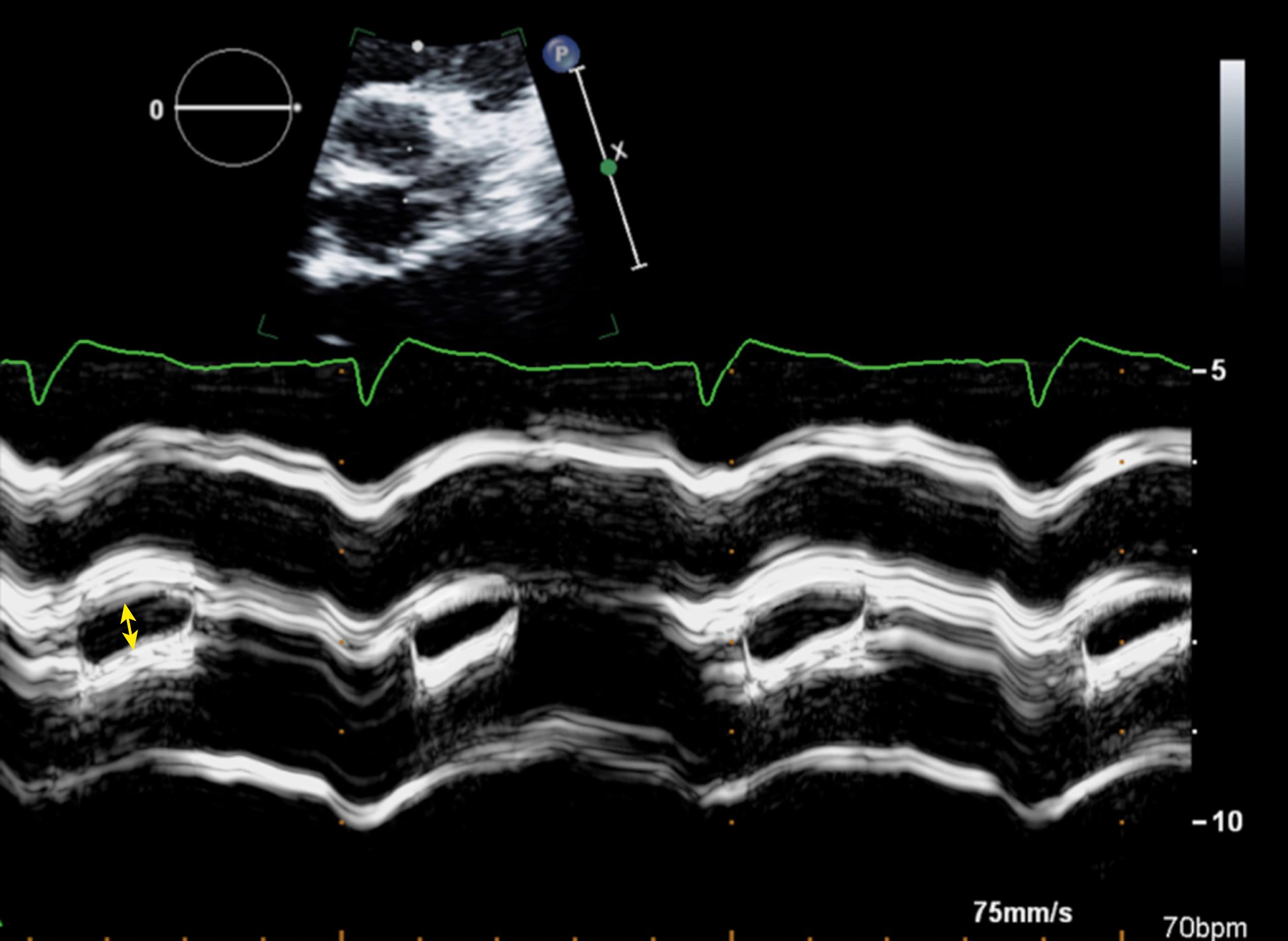 Figure 79.4, M-mode echocardiogram from a patient with moderate aortic stenosis. The maximal opening between the anterior (right coronary cusp) leaflet and a posterior leaflet (noncoronary cusp) (yellow arrow) is less than 5 mm.