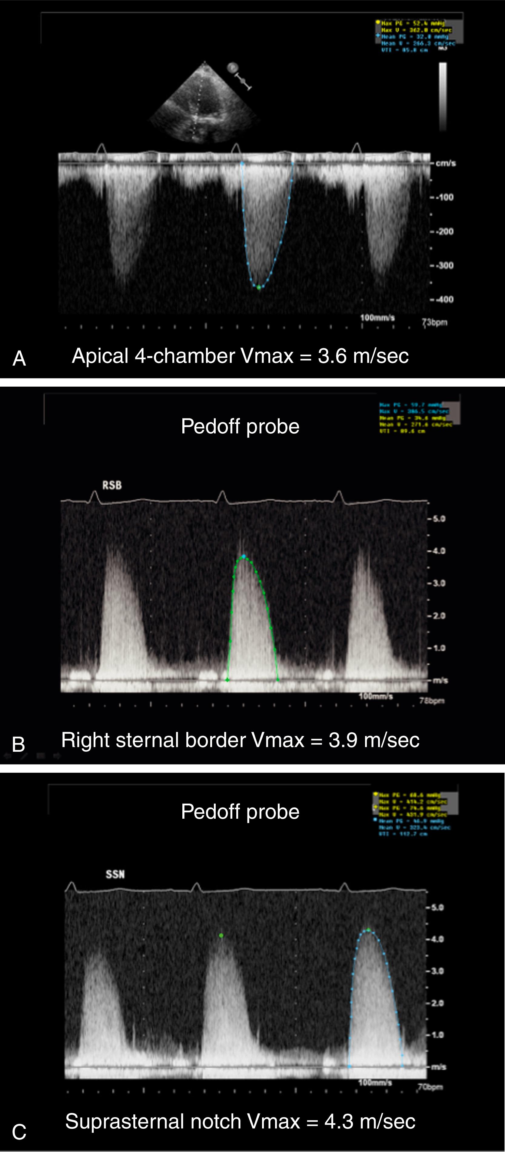 Figure 79.5, Continuous-wave Doppler tracings from a patient with severe aortic stenosis illustrate the importance of using multiple transducer positions to obtain the highest (maximal) transaortic velocity. A, Apical four-chamber view using imaging probe detects a velocity of 3.6 m/s. B, A slightly higher velocity (3.9 m/s) is obtained from the right sternal border using a nonimaging (Pedoff) probe. C, The highest velocity (4.3 m/s) was obtained from the suprasternal notch using a non-imaging probe.