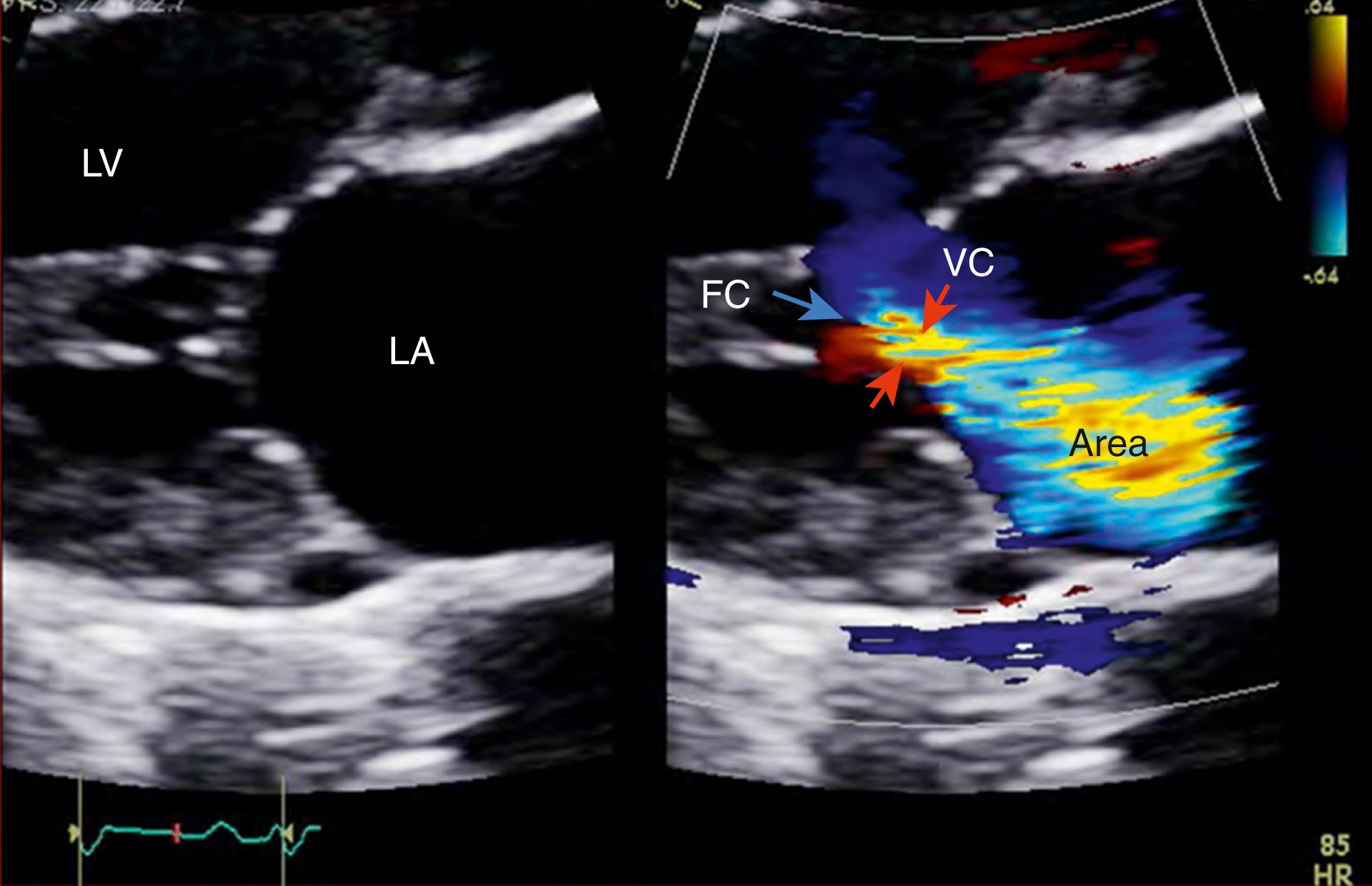 Figure 98.1, Depiction of the three components of a color flow regurgitant jet of mitral regurgitation: flow convergence (FC), used for the proximal isovelocity surface area method, vena contracta (VC), and jet area. LA, Left atrium; LV, left ventricle.