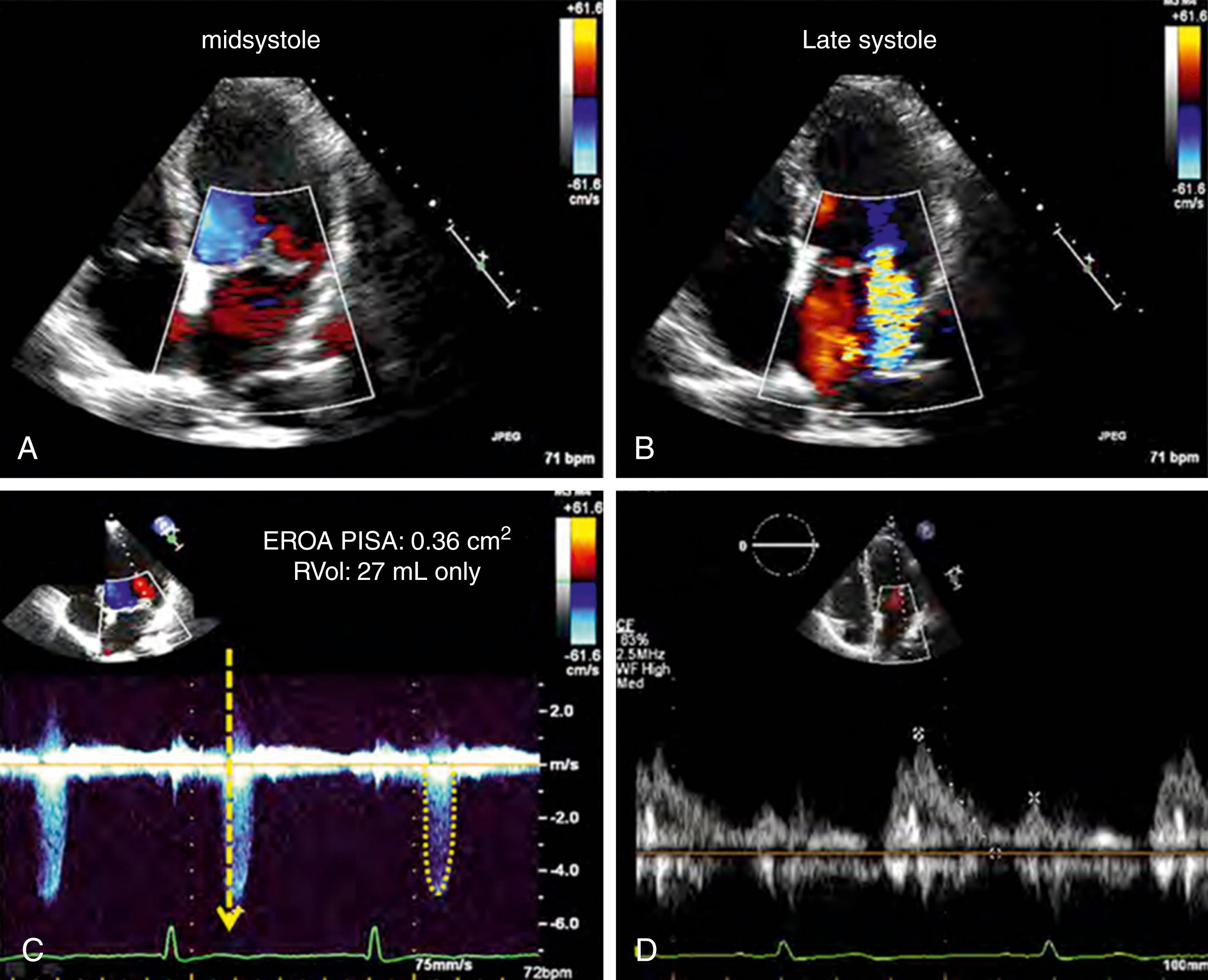 Figure 98.3, Late systolic mitral regurgitation (MR) in mitral valve prolapse (MVP). A, Midsystolic frame shows no MR by color Doppler. B, Late systolic frame shows an eccentric MR jet with a large flow convergence. C, Continuous-wave Doppler profile of MR jet demonstrates that MR is confined to late systole (onset at yellow arrow , small velocity time integral of jet, dotted contour ). D, Pulsed-wave Doppler of mitral inflow shows an E wave velocity of 75 cm/s with normal E/e′ ratio consistent with normal left atrial pressure. Calculation of effective regurgitant orifice area (EROA) overestimates the severity of regurgitation when the quantitation of regurgitation should rely on regurgitant volume (RVol) by either proximal isovelocity surface area (PISA) or volumetric measures (RVol, 27 mL).