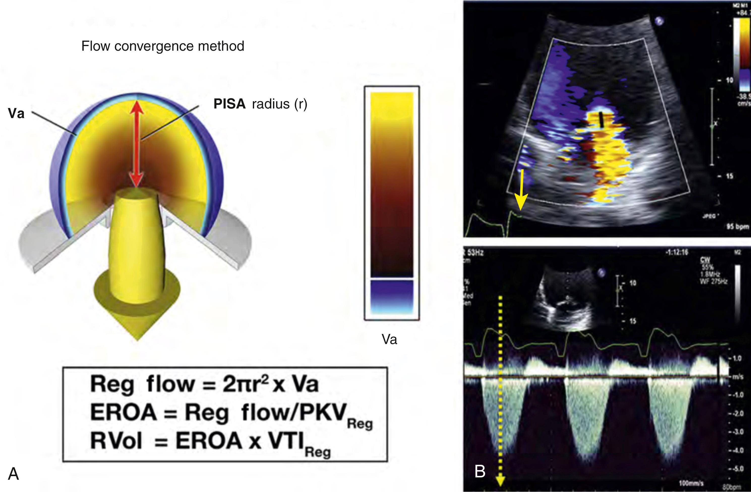 Figure 98.4, A, Schematic representation of the flow convergence method (PISA). B, Measurement of PISA radius and timing of the selection of the color frame for measurement (solid yellow arrow) , corresponding to the maximal jet velocity by continuous-wave Doppler (dashed arrow) . EROA, Effective regurgitant orifice area; PKV, peak velocity; Reg, regurgitant; RVol, regurgitant volume; VTI, velocity time interval.