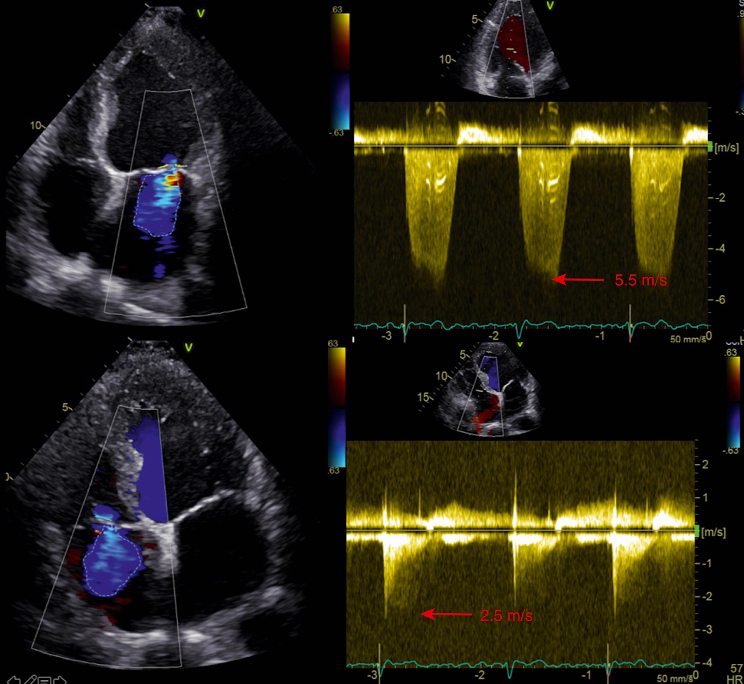 Figure 103.2, Misleading effect of jet area size to quantitate tricuspid regurgitation severity. The areas of the mitral (upper left) and tricuspid (lower left) regurgitant jets are similar in size (8.2 cm 2 and 7.6 cm 2 , respectively), but the driving forces (Vmax) across the two regurgitant orifices are quite different (5.5 m/s and 2.5 m/s, respectively) (right) . Accordingly, the regurgitant volume across the tricuspid valve is much larger than the one crossing the mitral valve