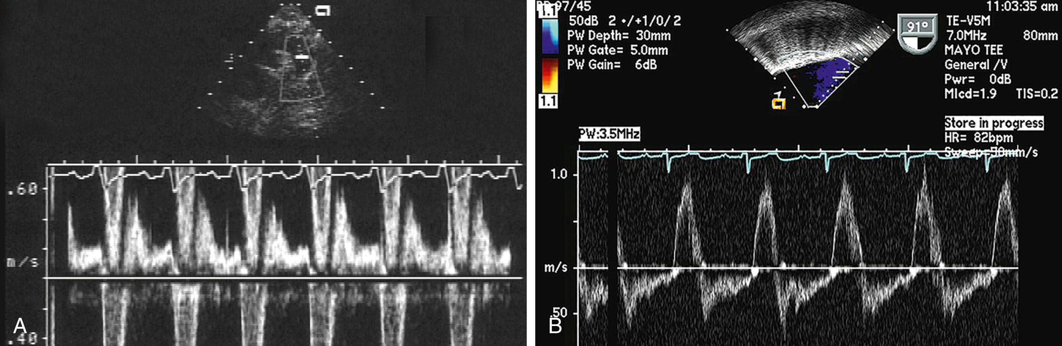 Figure 88.1, Holodiastolic flow reversal in the proximal descending thoracic aorta in a patient with severe aortic regurgitation on transthoracic study ( A ) and transesophageal study ( B ).